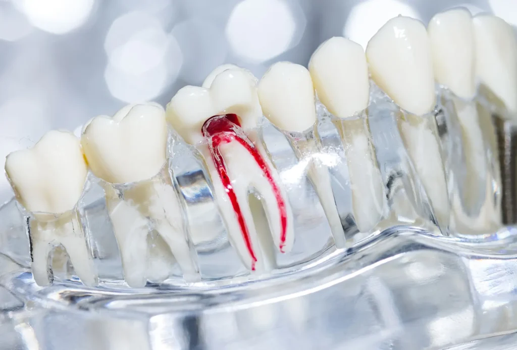 Cavity Treatment in Flower Mound, TX