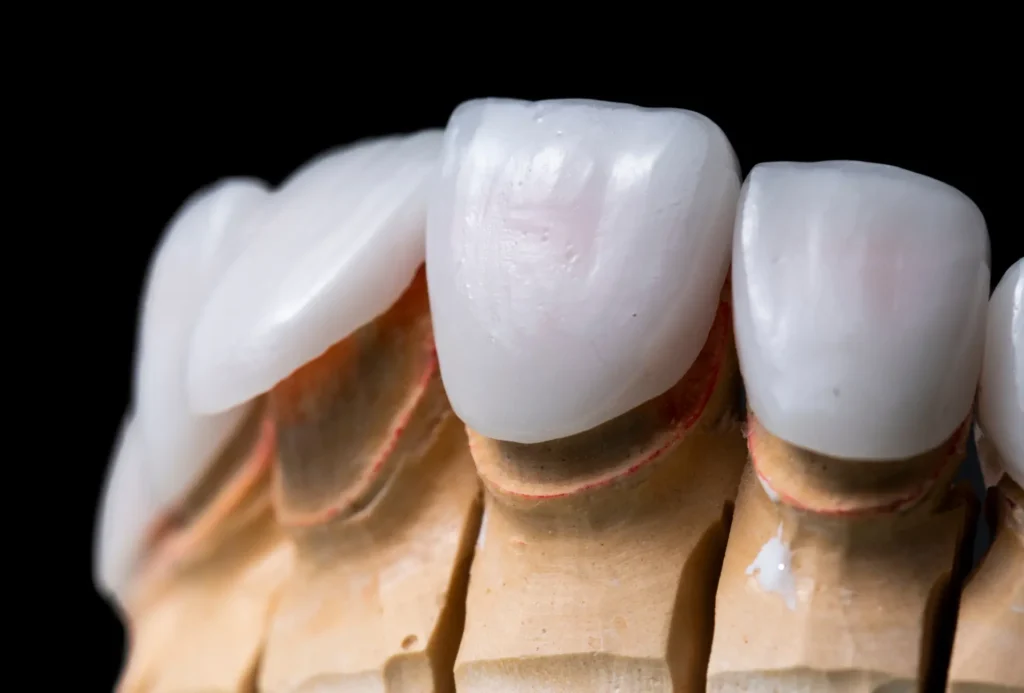 Dental Veneers in Flower Mound, TX