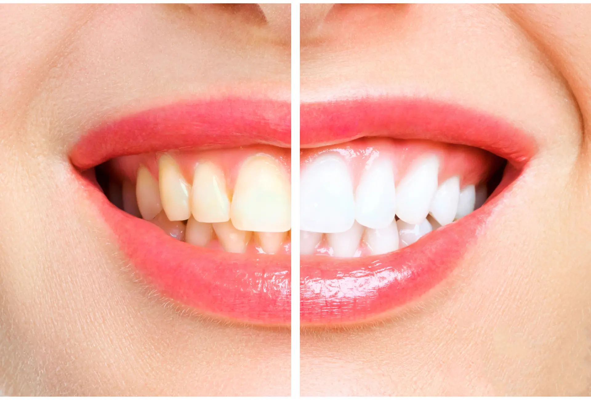 Teeth Whitening Services in Flower Mound, TX