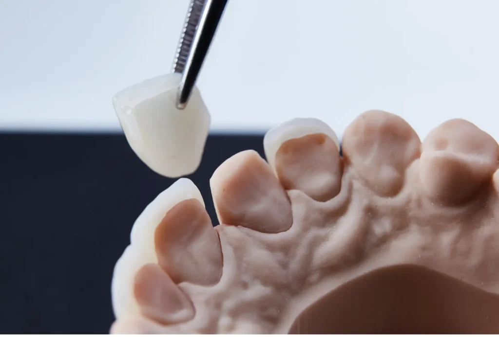 What Are Dental Veneers