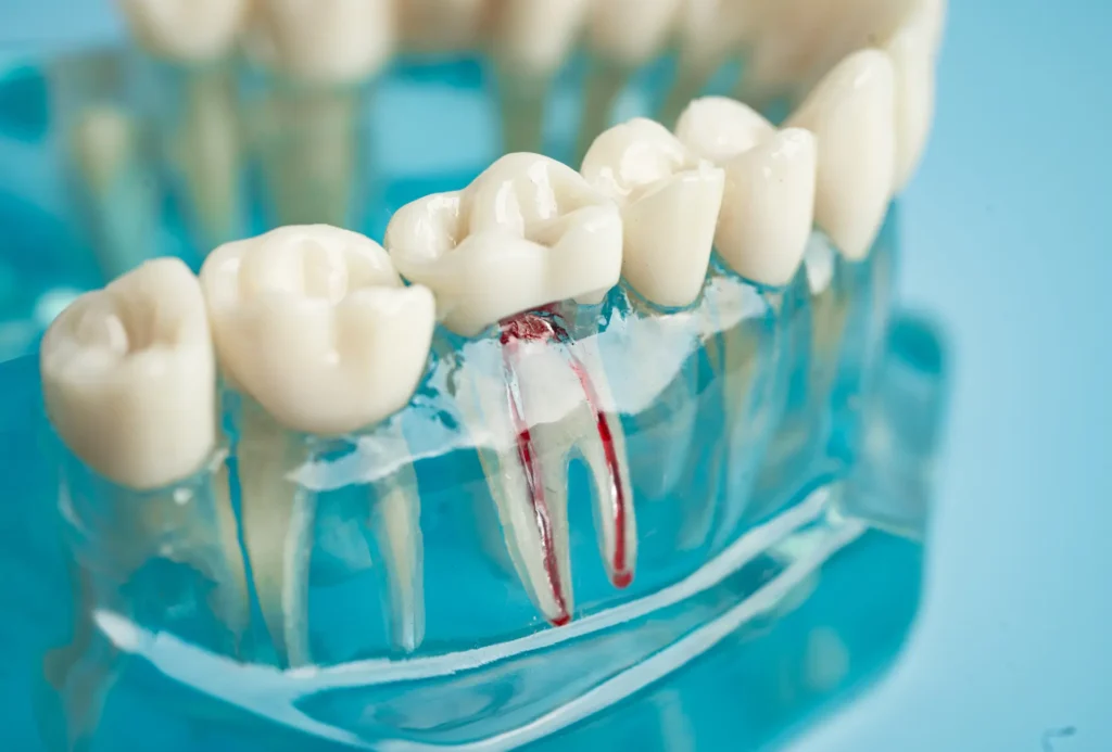 What Is Cavity Treatment