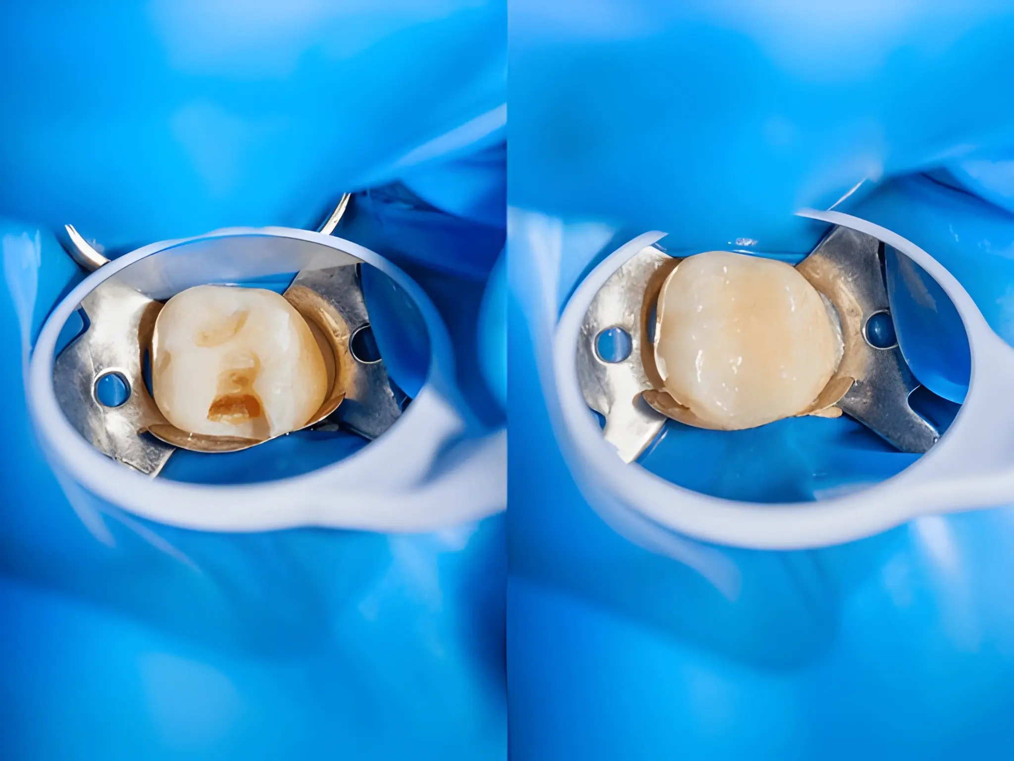 Dental filling in Flower Mound TX close-up before and after composite tooth restoration at Supreme Smiles Dentistry.