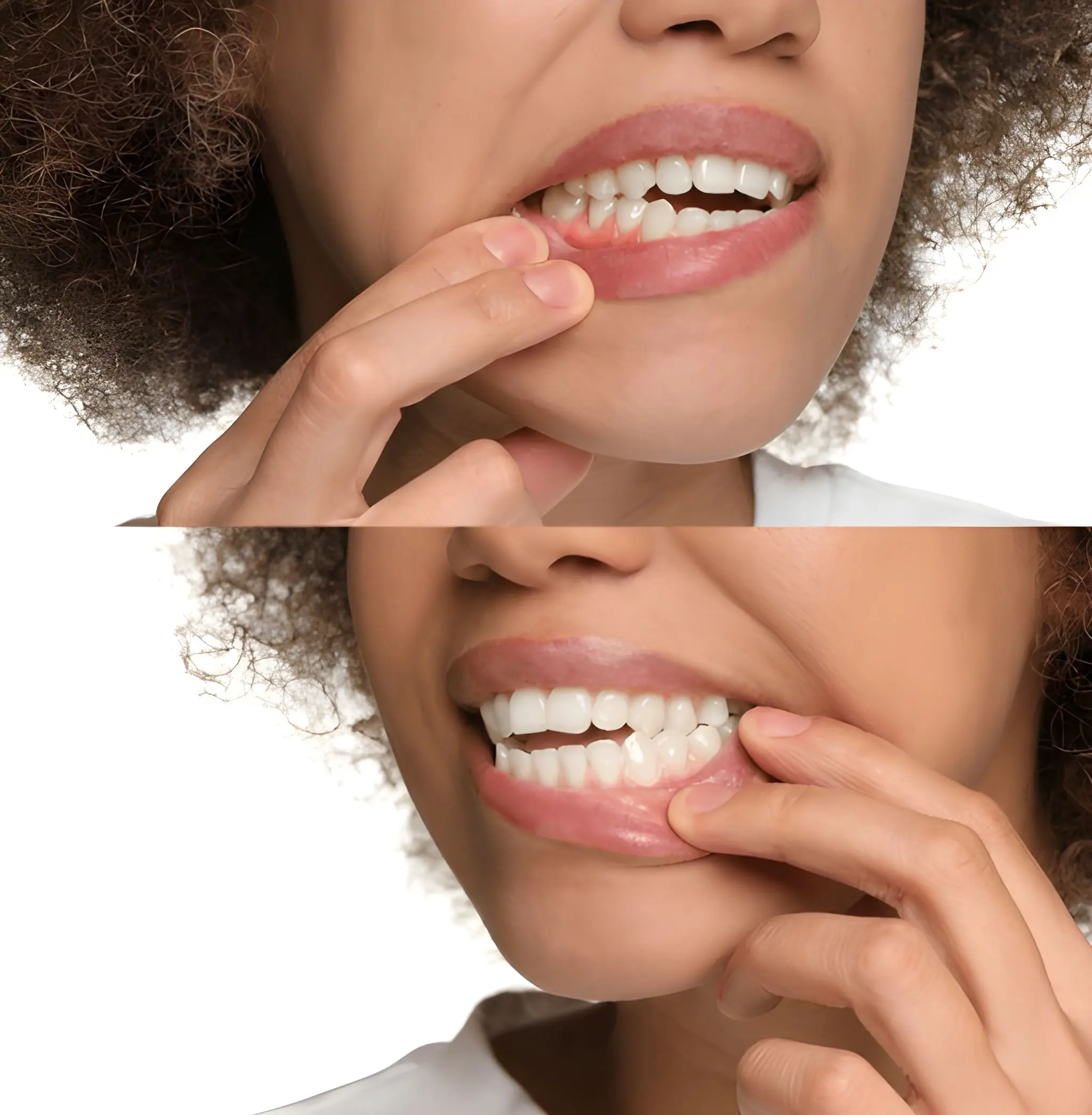 Gum disease treatment in Flower Mound TX before and after results showing healthier gums after professional cleaning and scaling.