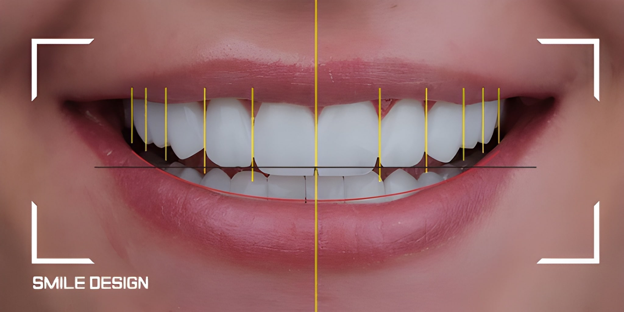 Restorative Dentistry Flower Mound TX smile design planning for precise tooth alignment and aesthetic restoration.