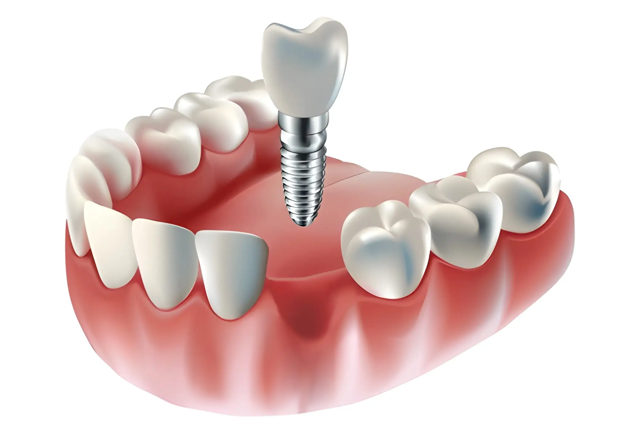 Tooth implant Flower Mound TX model with titanium post and ceramic crown at Supreme Smiles Dentistry
