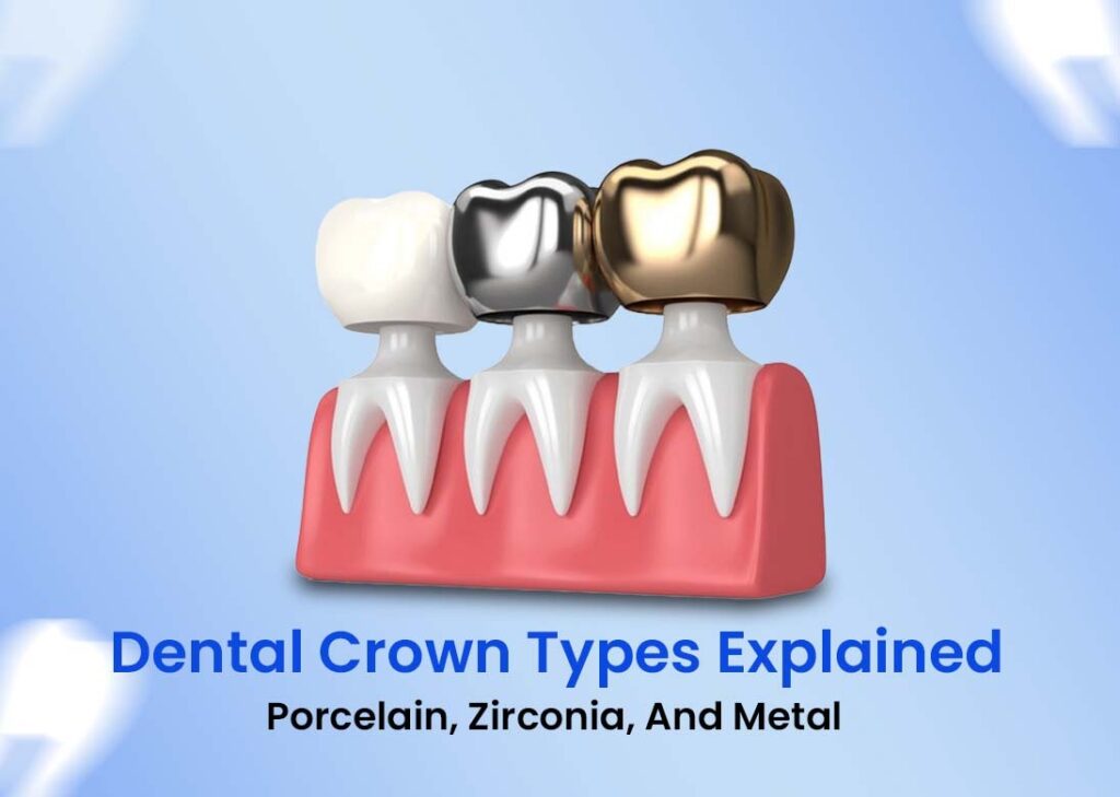 Dental Crowns Supreme Smiles TX illustration showing porcelain, zirconia, and metal crown types explained