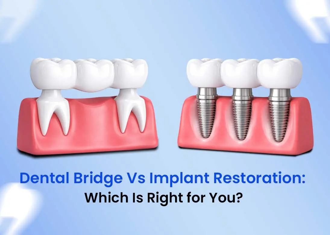 dental bridge vs dental implant restoration
