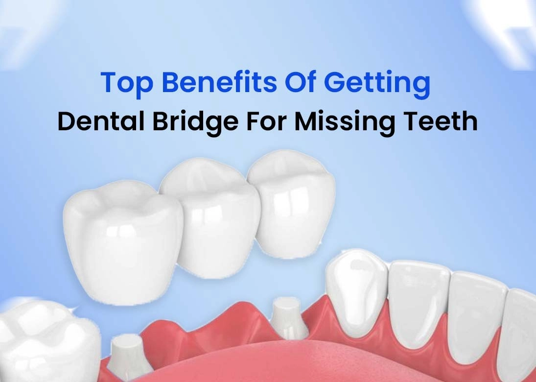 Top Benefits of Getting a Dental Bridge for Missing Teeth