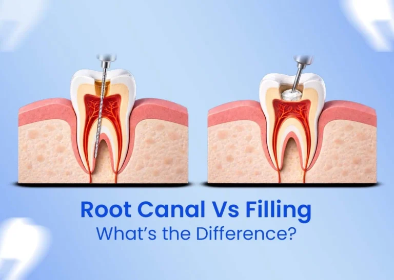 Root Canal vs Filling What’s the Difference