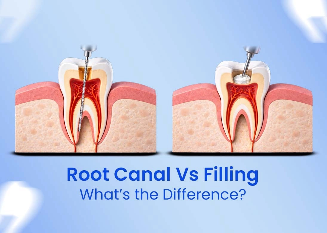 Root Canal vs Filling What’s the Difference