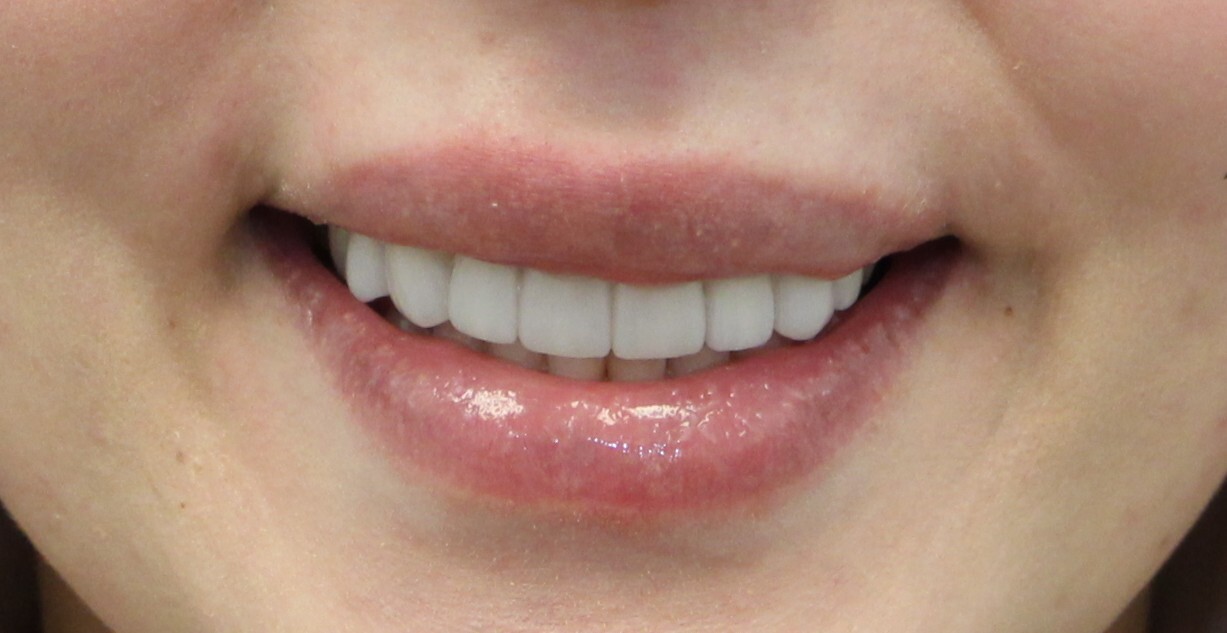 after veneer treatment