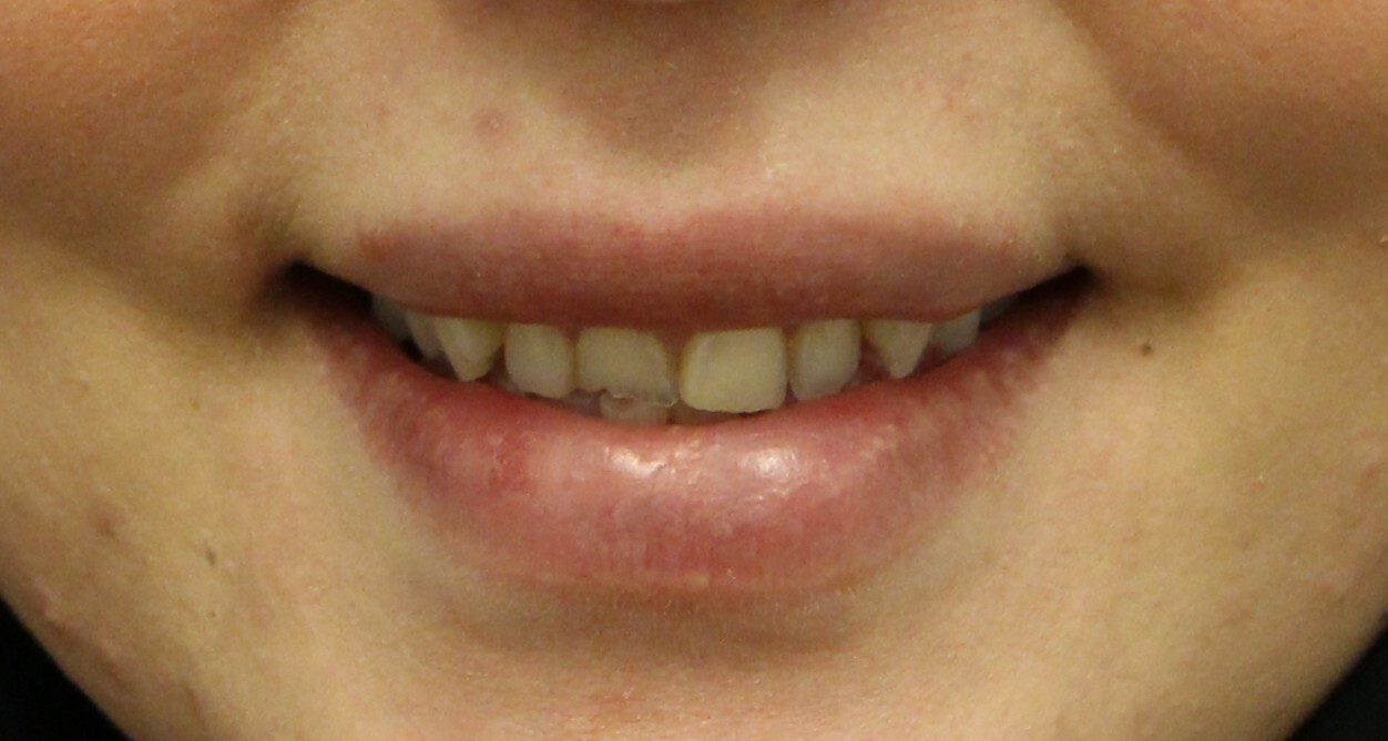 before veneers treatment