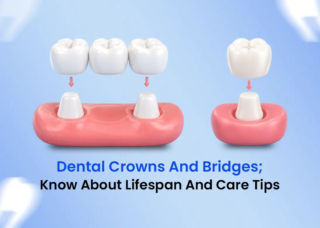 Dental Crowns and Bridges; Know About Lifespan and Care Tips